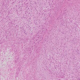 Pathological Findings A Macroscopic Findings The Cut Surface Of