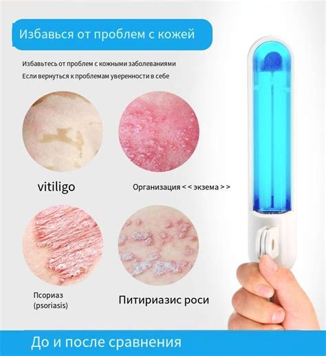 Инструмент для фототерапии UVB 311 нм, ультрафиолетовый свет UVB для ...