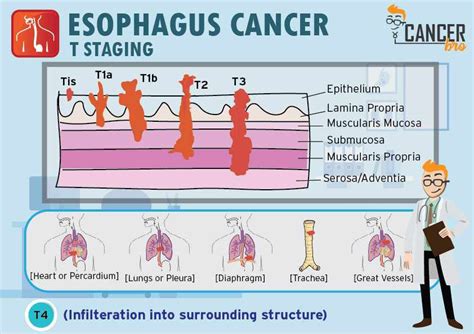 Esophageal Cancer TNM Staging Explained In Detail – Site Title