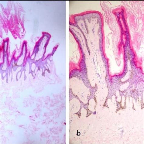 A Papillomatosis And Hyperkeratosis In Epidermis He X 40 B