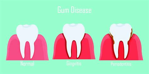 Warning Signs You Need Periodontal Treatment For Advanced Gum Disease