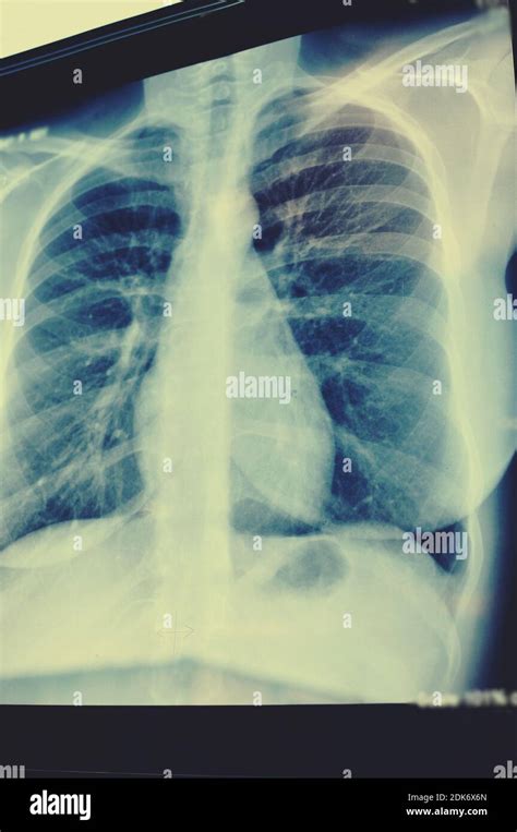 Imagen De Radiografía De Los Pulmones Radiografía De Tórax O Pulmón