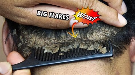 Omg Scratching Giant Itchy Flakes From Scalp Dandruff Flakes 418 Youtube