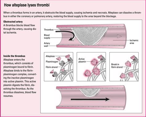 Alteplase – How Does It Work? |Lippincott NursingCenter