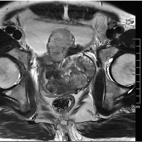 Magnetic Resonance Imaging Mri Of One Of The Prostatic Msfts Pelvic Download Scientific