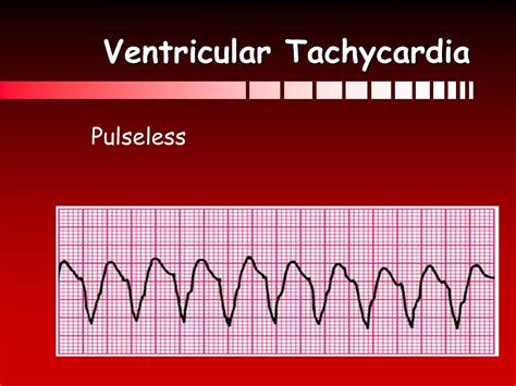 Ventricular Tachycardia Ppt