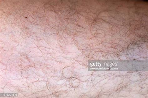 38 Black Skin Rash Stock Photos, High-Res Pictures, and Images - Getty ...