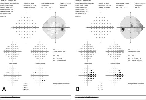 Automated Perimetry Examination Of Both Eyes The Right Visual Field Is