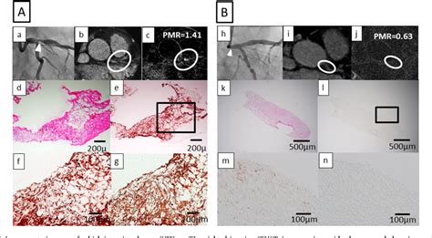 Figure From Relationship Of High Intensity Plaques On T Weighted