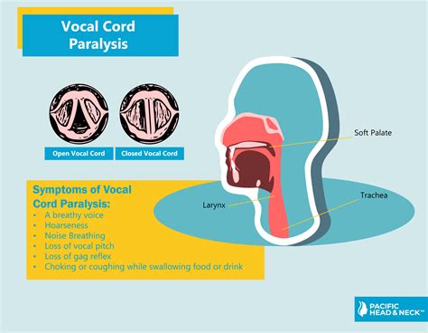 vocal cord paralysis pacific head neck