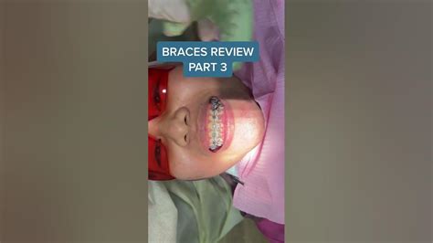 Braces Review Part 3 Acknowledging Teeth Movement Youtube