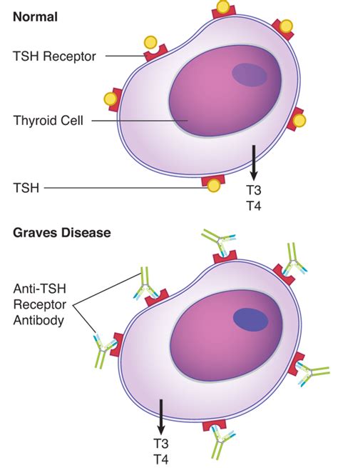 Antibodies to the TSH Receptor in Graves Disease | Graves disease, Tsh ...