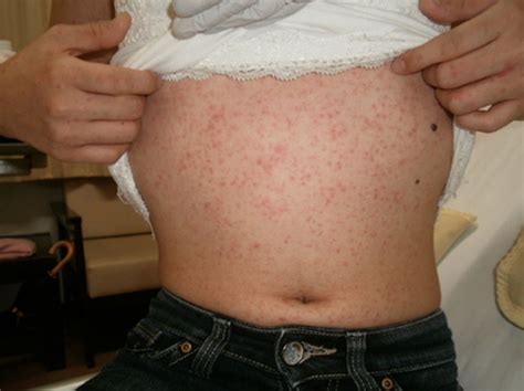 Mononucleosis Amoxicillin Rash Https Amjmed Article S