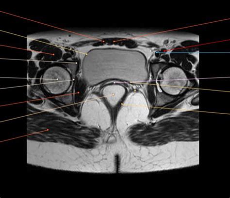 Diagram Of Female Pelvis Axial Mri Quizlet