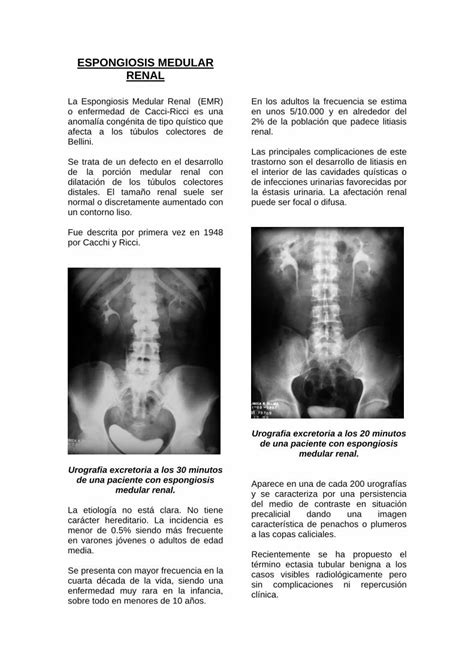 Pdf Espongiosis Medular Renal Inen Sld Pe Dokumen Tips