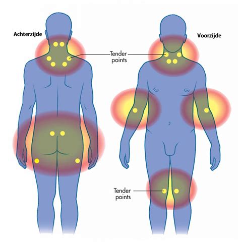 Fibromyalgie Wat Is Het Artofit