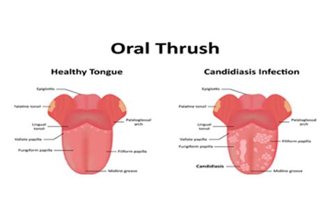 Oral Thrush