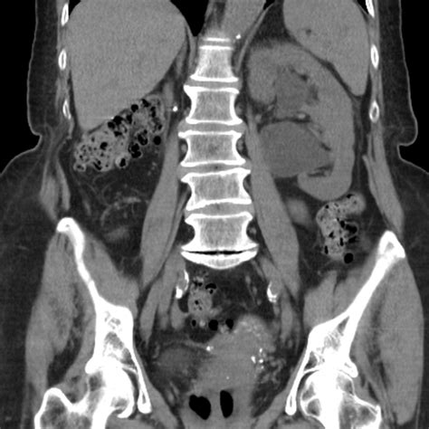 Upj Obstruction Causes Symptoms Treatment Upj Obstruction