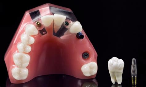 Elevaci N De Seno Maxilar Para La Colocaci N De Implantes Dentales