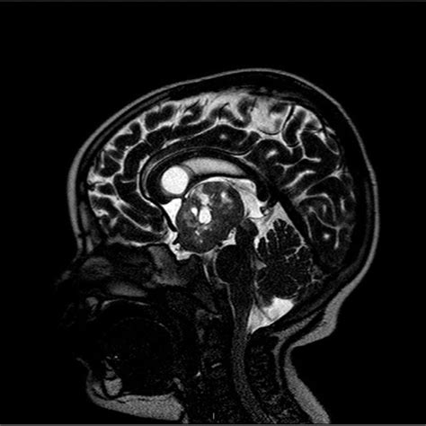 Pre Operative Sagittal Mri Of Case Download Scientific Diagram