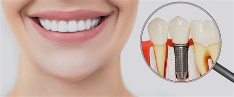 Cost Of Dental Implants In Houston Tx Muse Dental Studio