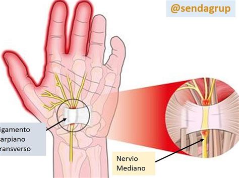 Tratamiento Para El Sindrome De Tunel Del Carpo