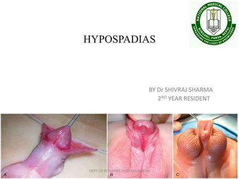 Hypospadias Ppt