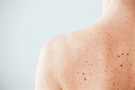 Skin Checks Dermatology And Skin Health Dr Mendese