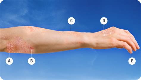 Plaque Psoriasis Signs and Symptoms