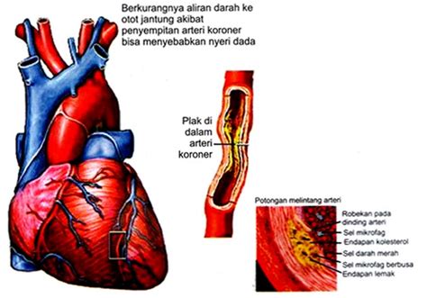 Jenis Jenis Penyakit Dalam Penyakit Dan Gambar Jantung