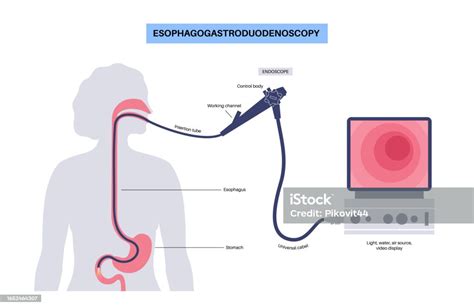 Esophagogastroduodenoscopy Medical Procedure Stock Illustration