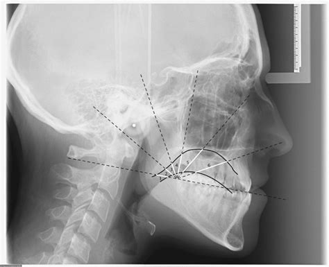 Assessment Of Tongue Posture On Lateral Cephalograms A Template Black