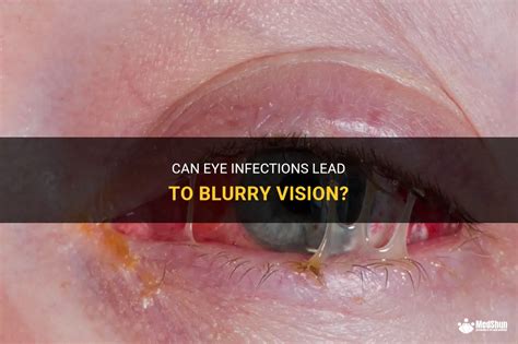 Can Eye Infections Lead To Blurry Vision Medshun