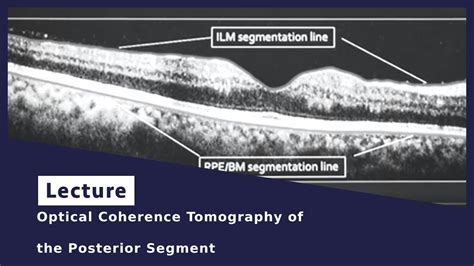 Optical Coherence Tomography Of The Posterior Segment YouTube