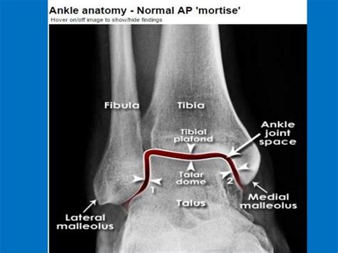 Medial Malleolus Bone Spur Anterior Ankle Impingement Dynamic Physio