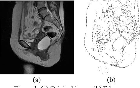 Figure 1 from MRI-based semi-automatic pelvimetry measurement for pelvic organ prolapse ...