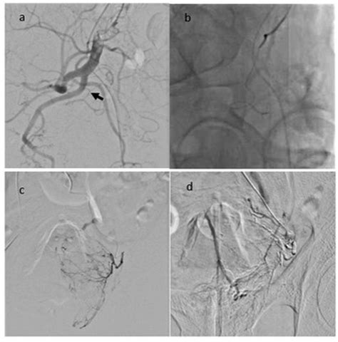 Images From Prostate Arterial Embolization A Left Internal Iliac Download Scientific Diagram