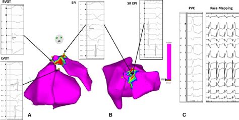 Combined Endoepicardial Voltage Maps Of The Right And Left Ventricular