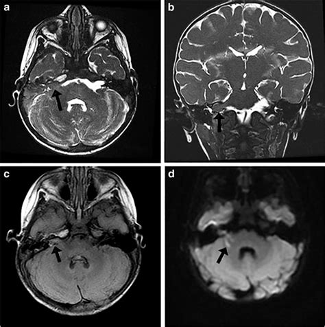 Preoperative Mri Of The Right Cerebellopontine Angle Mass A Axial And