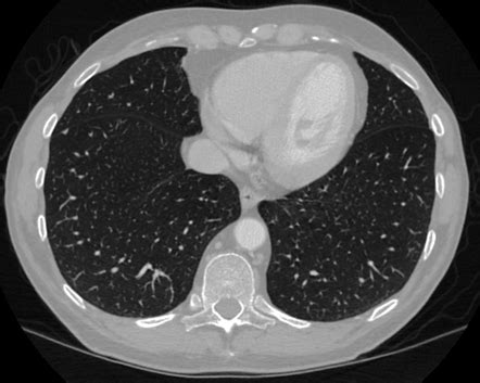 Typical perifissural nodule | Radiology Case | Radiopaedia.org