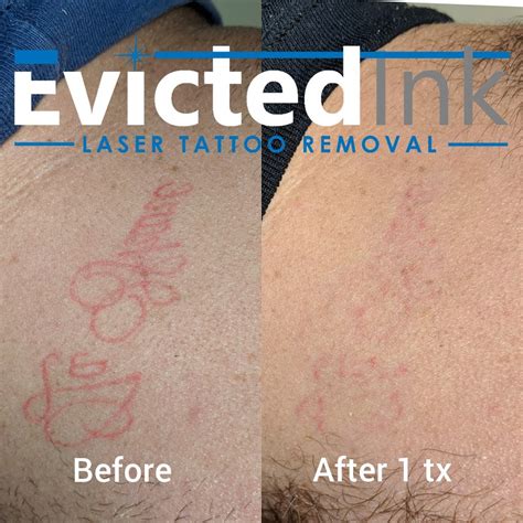 Evicted Ink Laser Tattoo Removal Before And After Images