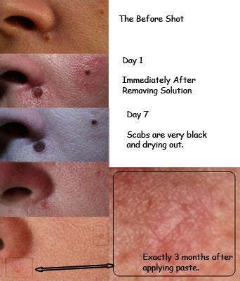 ﻿Truths About Laser Mole Removal