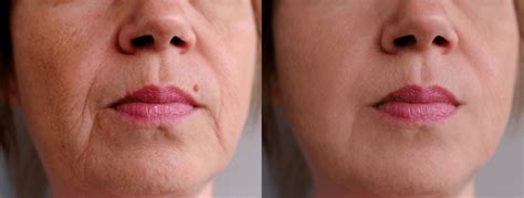 Before And After Mole Removal Over 127 Royalty Free Licensable Stock