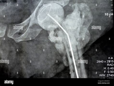 Plain X Ray Hip Joint Show Left Trans Cervical Fracture Of The Head Of