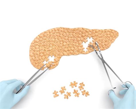 Fibrocalculous Pancreatic Diabetes Causes Symptoms And Treatment