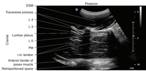 Lumbar Paravertebral Sonography And Considerations For Ultrasound