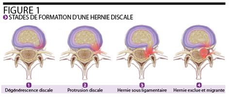 Kin Prise En Charge D Un Patient Atteint D Une Hernie Discale Kine