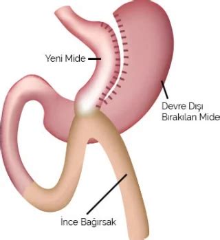 Mide Küçültme Ameliyatı Gastrik Bypass Tüp Mide Ameliyatı