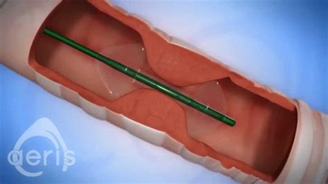 Introducing Aeris A Balloon Catheter For Treatment Of Airway Stenosis