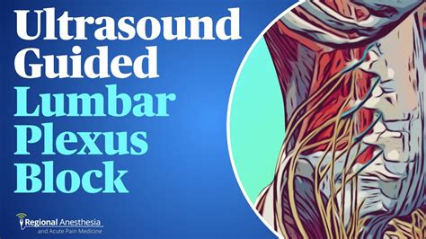 Ultrasound Guided Lumbar Plexus Block Youtube